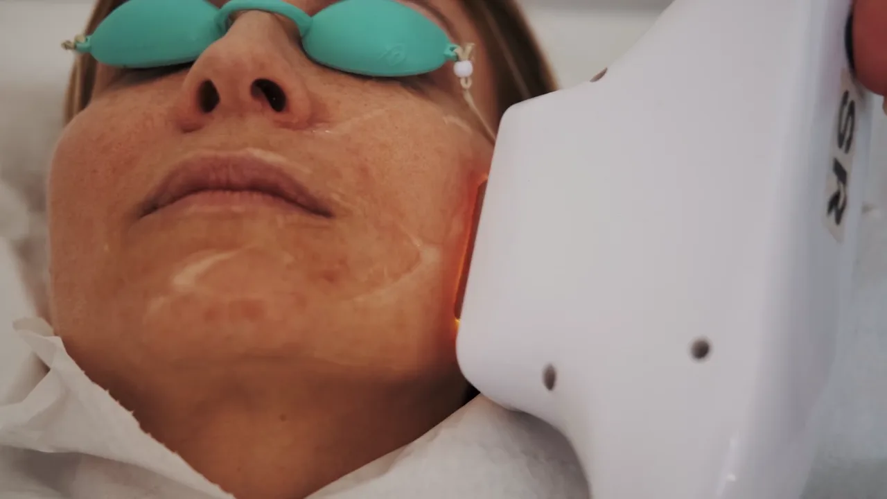 Pièce à main IPL passée sur le visage d'une personne portant des lunettes de protection, pendant une séance